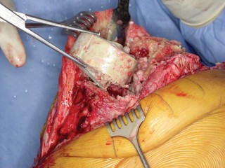 Illustration 44 for PROSTALAC Articulating Spacer: Treat Infected Knees, Regain Mobility