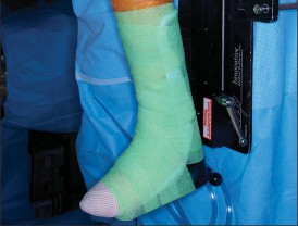 Illustration 18 for PROSTALAC Articulating Spacer: Treat Infected Knees, Regain Mobility