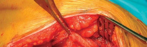 Illustration 28 for Direct Lateral Hip: Optimize Exposure with Sharp Curved Hohmann