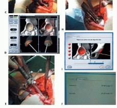 Illustration 25 for Hip Resurfacing: The Bone-Sparing Solution around the Femoral Head