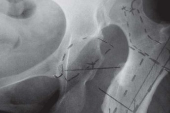 Illustration 21 for Successful Total Hip Replacement in Developmental Dysplasia