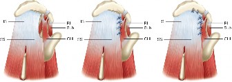 Illustration 4 for Irreparable Rotator Cuff Tears: What Are Your Treatment Options?