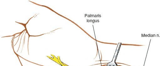 Illustration 64 for Essential Surgical Approaches: Uncover Every Aspect of the Wrist