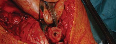 Illustration 80 for S-ROM: Inside the Technique of Modular Implant Design