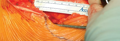 Illustration 16 for Direct Lateral Hip: Optimize Exposure with Sharp Curved Hohmann