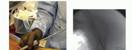 Illustration 35 for Emergency Fixation of the Pelvis: Control Bleeding & Restore Stability