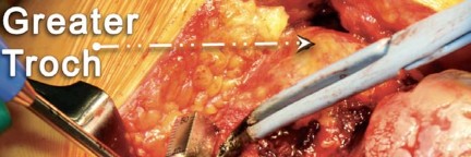 Illustration 70 for Birmingham Hip Resurfacing Designer's Technique for Active Lives