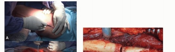 Illustration 18 for Mastering Fixation of Periprosthetic Fractures of the Femur