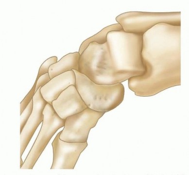 Illustration 5 for Why Anterior Tibialis Muscle Transfer Fixes Clubfoot