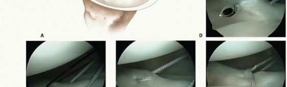 Illustration 5 for Relief for MDI: Expert Treatment of Multidirectional Shoulder Instability