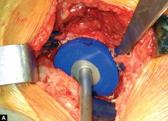 Illustration 21 for Optimizing Acetabular Component Cementation for Superior Outcomes