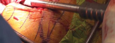 Illustration 40 for THA for patients with proximal femoral deformity: Practical solutions