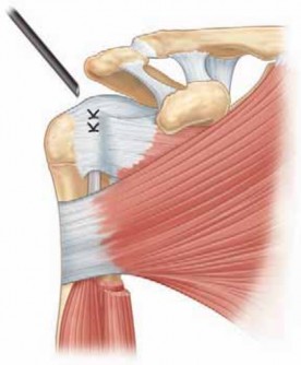 Illustration 15 for Resolve Long Head Biceps Pain: Advanced Arthroscopic Treatment