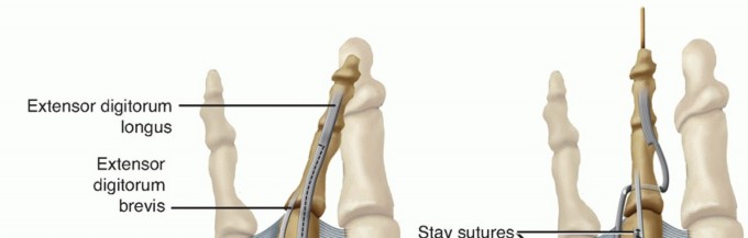 Illustration 12 for Toe Deformity Pain? Rebalance Flexor to Extensor for Relief