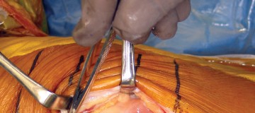 صورة طبية: استبدال مفصل الركبة بالحد الأدنى من التدخل الجراحي: ألم أقل وتعافٍ أسرع مع النهج شبه الرضفي الإنسي