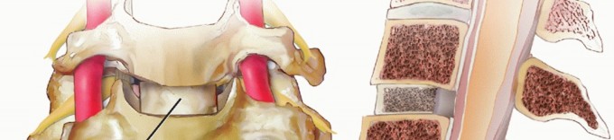 Illustration 33 for How ACDF Clears Your Posterior Disc Space for Lasting Relief