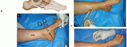 Illustration 19 for How Achilles Tendon Lengthening Fixes Equinocavovarus Foot