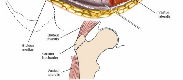 Illustration 113 for Unlocking Every Aspect of the Hip's Surgical Approaches