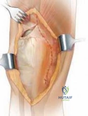 Illustration of exposure vy quadroplasty - Dr. Mohammed Hutaif