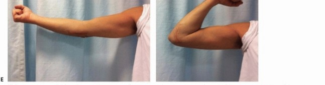 Illustration 7 for Restore Stability & Motion: Fixation of Fracture-Dislocations