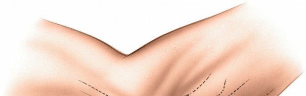 Illustration 88 for Mastering Elbow Approaches: Applied Surgical Anatomy for Precision