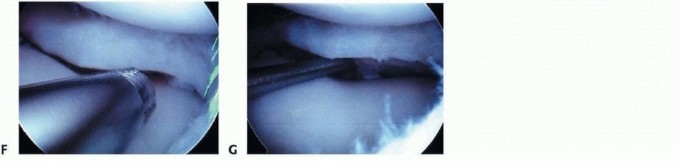 Meniscoplasty: Your Solution for Discoid Lateral Meniscus Pain