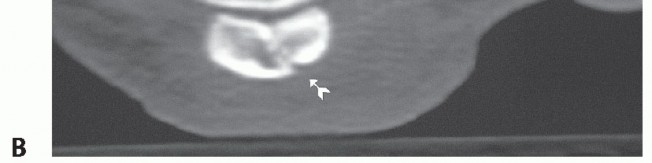 Illustration 7 for Optimizing Internal Fixation of Sesamoid Fractures
