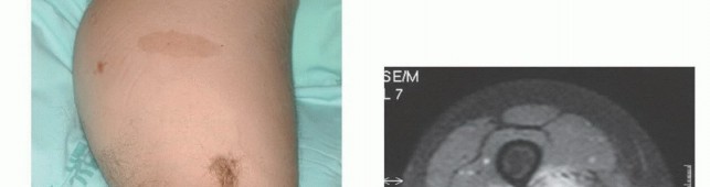 Illustration 6 for Posterior Thigh Resection: Rethinking Outcomes & Limb Sparing