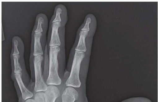 Thumb Carpometacarpal Arthrodesis