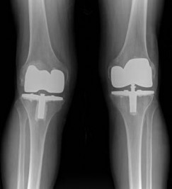 Illustration of erythrocyte sedimentation rate esr - Dr. Mohammed Hutaif