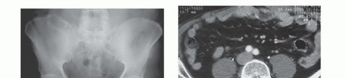 Illustration 38 for Pelvic Metastasis Surgery: A Component of the Utilitarian Approach