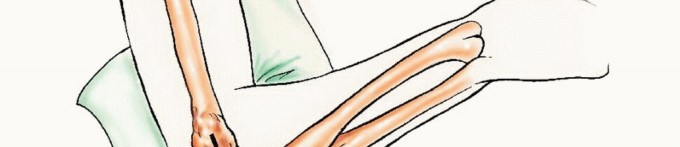 Illustration 35 for Restore Vital Function: Surgery for Type II Humeral Metastasis