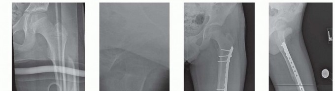 Illustration of pediatric femur fractures - Dr. Mohammed Hutaif