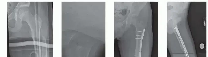 صورة توضيحية لـ كسور عظم الفخذ عند الأطفال: دليلك الشامل لخيارات العلاج والتعافي مع الأستاذ الدكتور محمد هطيف