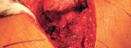 Illustration 45 for Metal on Metal Resurfacing: Enhanced Posterior Soft Tissue Repair