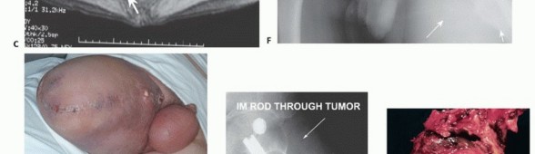 Illustration 6 for Posterior Flap Hemipelvectomy: Mastering Techniques for Optimal Outcomes