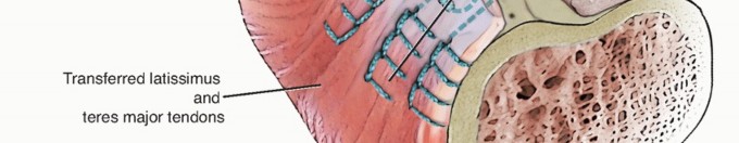 Illustration 34 for Restore Shoulder Function with Latissimus Dorsi Tendon Transfer