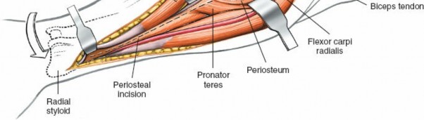 Illustration 15 for Radius Anterior Approach: Safe Nerve Protection & Complete Exposure