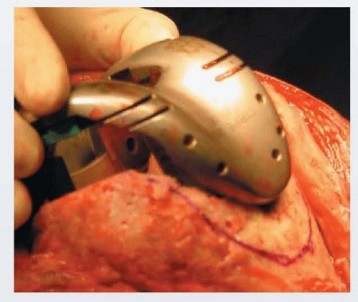 Illustration 23 for Femoral Bone Loss: Metal Augments for Revision Knee Success