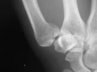 صورة توضيحية لـ كسر بينيت في الإبهام: دليل شامل للتشخيص والعلاج والتعافي مع الأستاذ الدكتور محمد هطيف في صنعاء