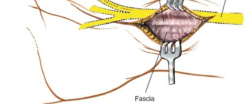 Illustration 16 for Volar Approach: Optimal Exposure for the Volar aspect of the Distal Radius