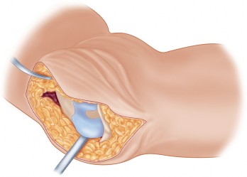 Illustration 17 for Arthrodesis with an Intramedullary Nail: Fixing Failed TKAs