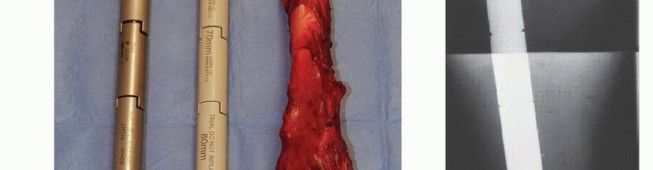 Illustration 15 for Distal Femoral Replacement: Key to Modern Limb Salvage