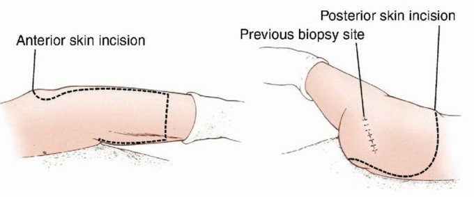 Illustration 8 for Anterior Flap Hemipelvectomy: Leveraging fig tech fig for Difficult Tumors