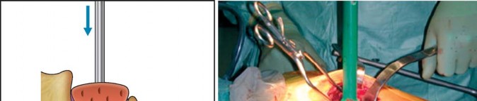 Illustration 4 for Optimizing Acetabular Component Cementation for Superior Outcomes