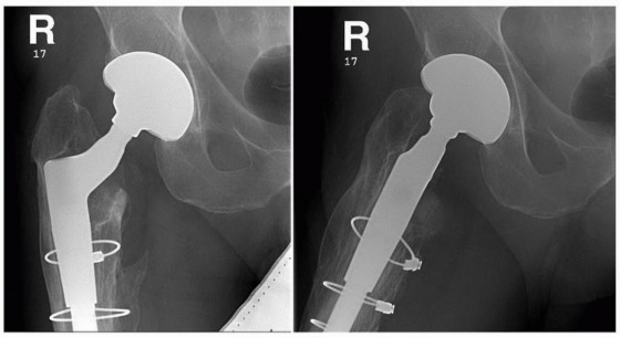 Illustration 10 for Mastering Revision THA: Strategies for Adverse Local Tissue Challenges