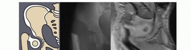 Illustration 5 for Treatment for Congenital Femoral Deficiency: What You Need to Know