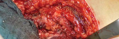 Illustration 58 for Collum Femoris Preserving: Achieve Better Primary Hip Outcomes