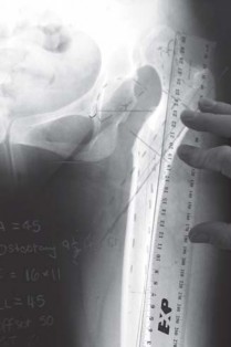 Illustration 25 for Successful Total Hip Replacement in Developmental Dysplasia