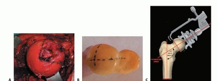 Illustration 7 for Hip Resurfacing: The Bone-Sparing Solution around the Femoral Head